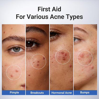 1.8% Salicylic Acid Acne Spot Treatment Drying Lotion