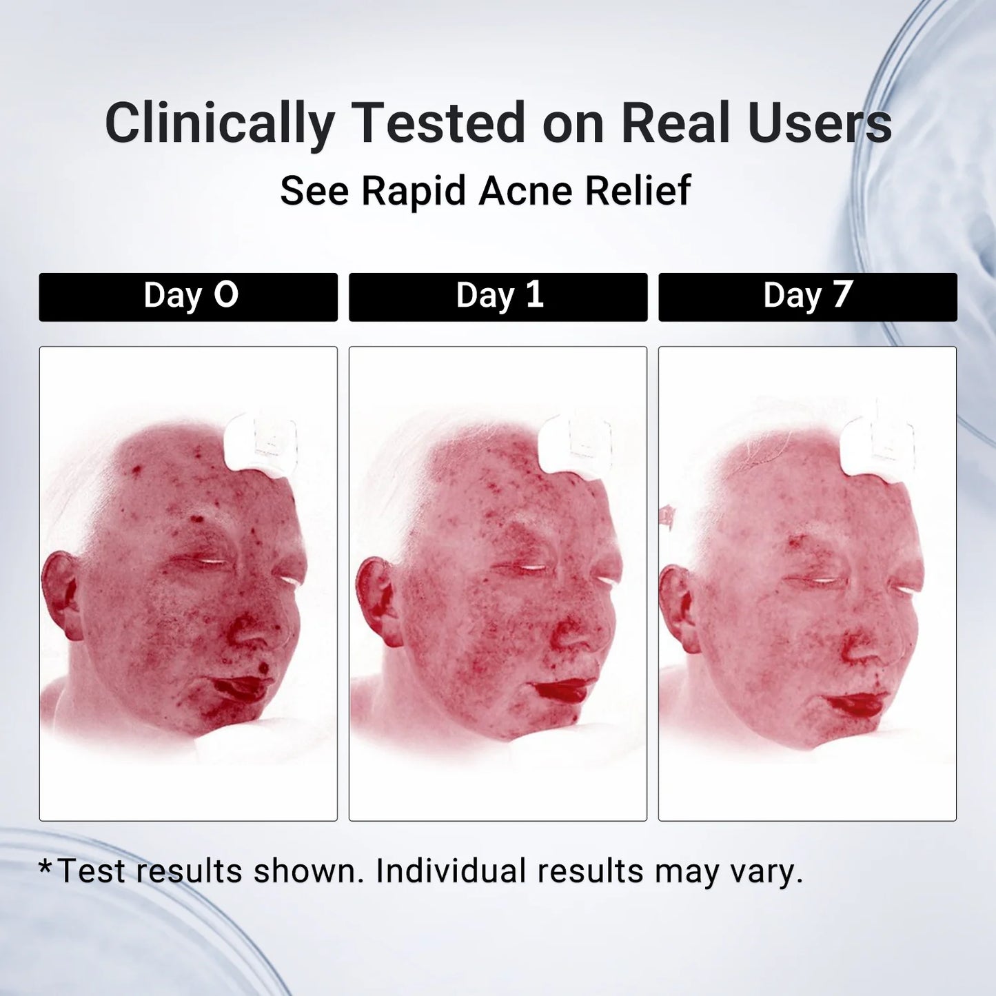 1.8% Salicylic Acid Acne Spot Treatment Drying Lotion