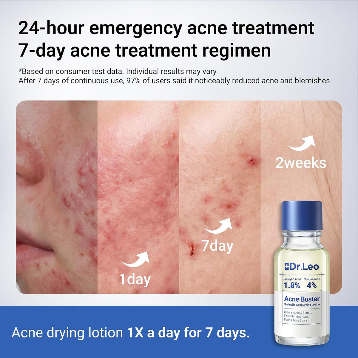 1.8% Salicylic Acid Acne Spot Treatment Drying Lotion