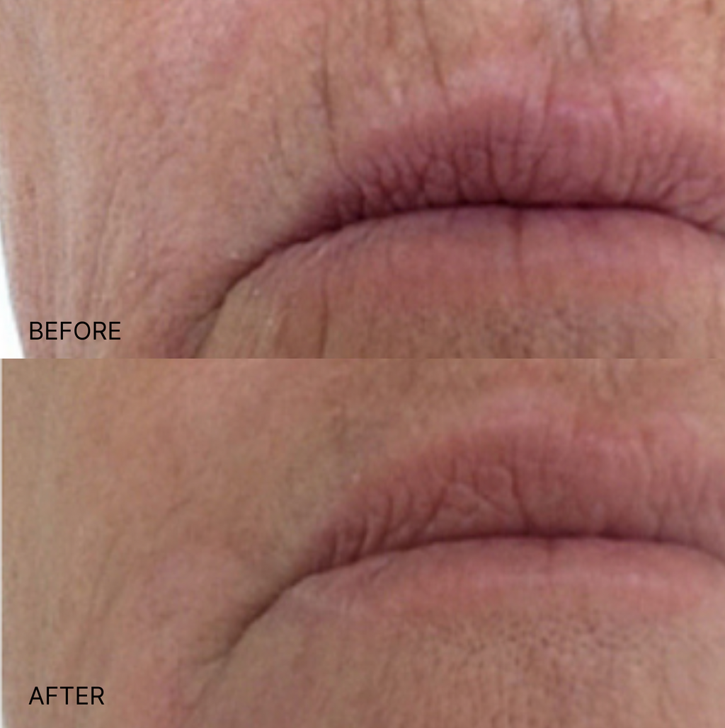 Ultimate Wrinkle Smoothing Set