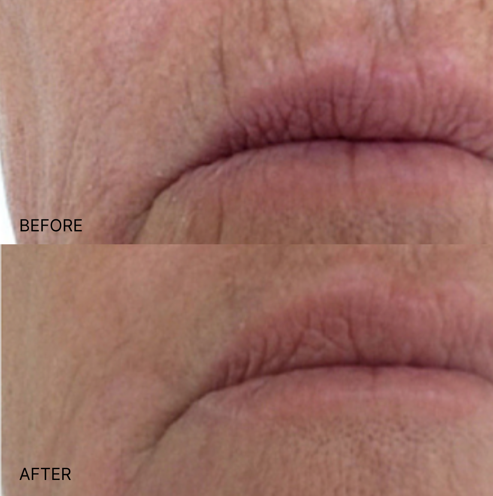 Ultimate Wrinkle Smoothing Set