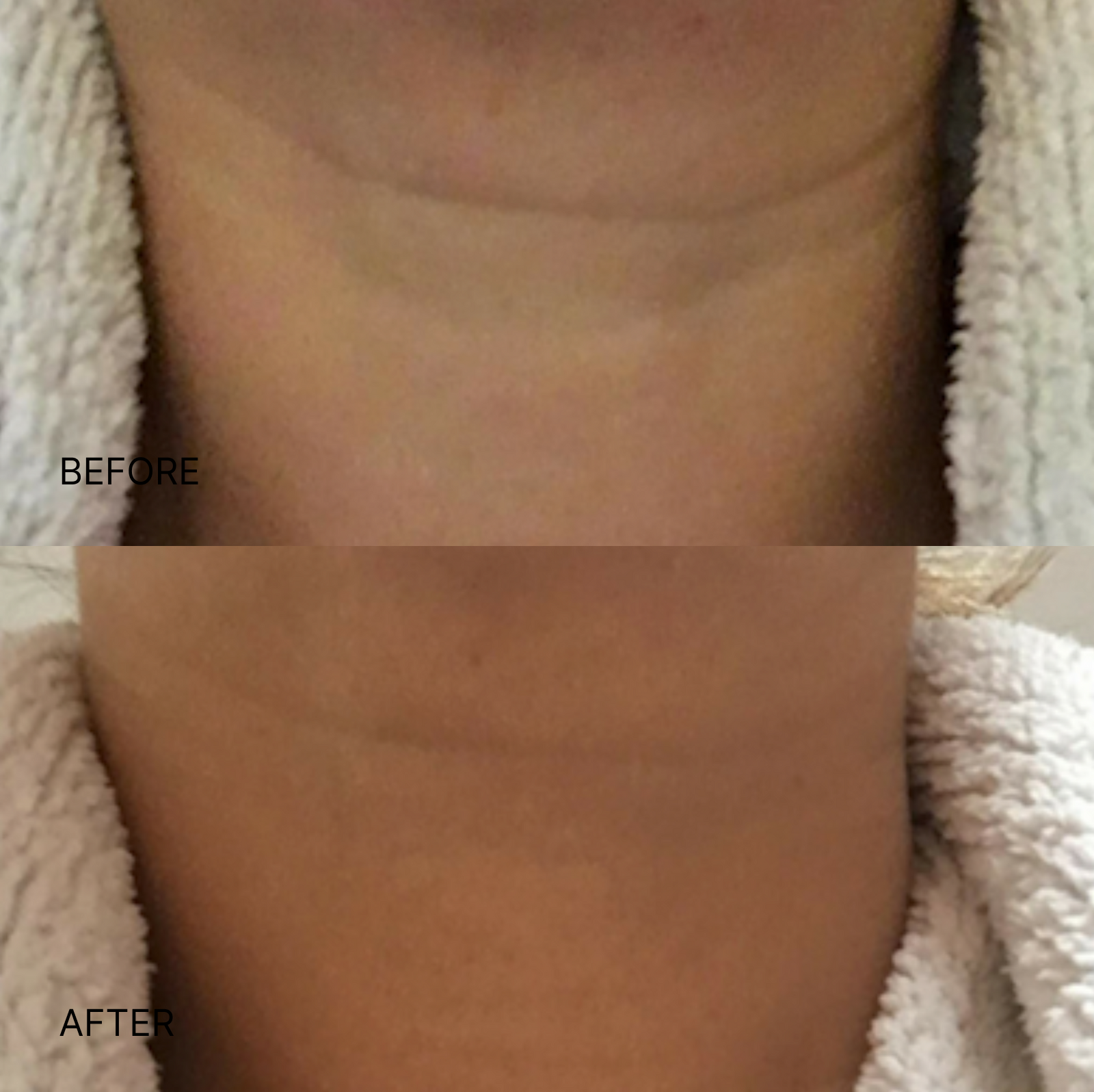 Wrinkle Smoothing Neck Patch